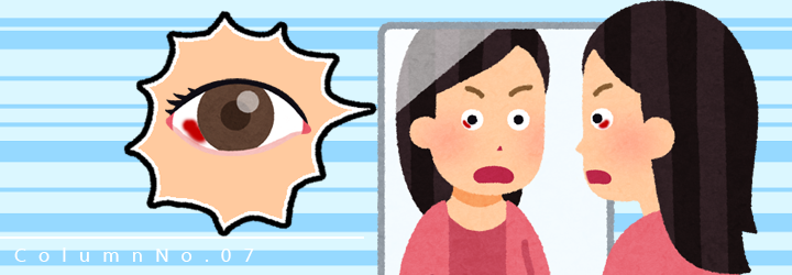目が真っ赤！出血？充血？『結膜下出血』